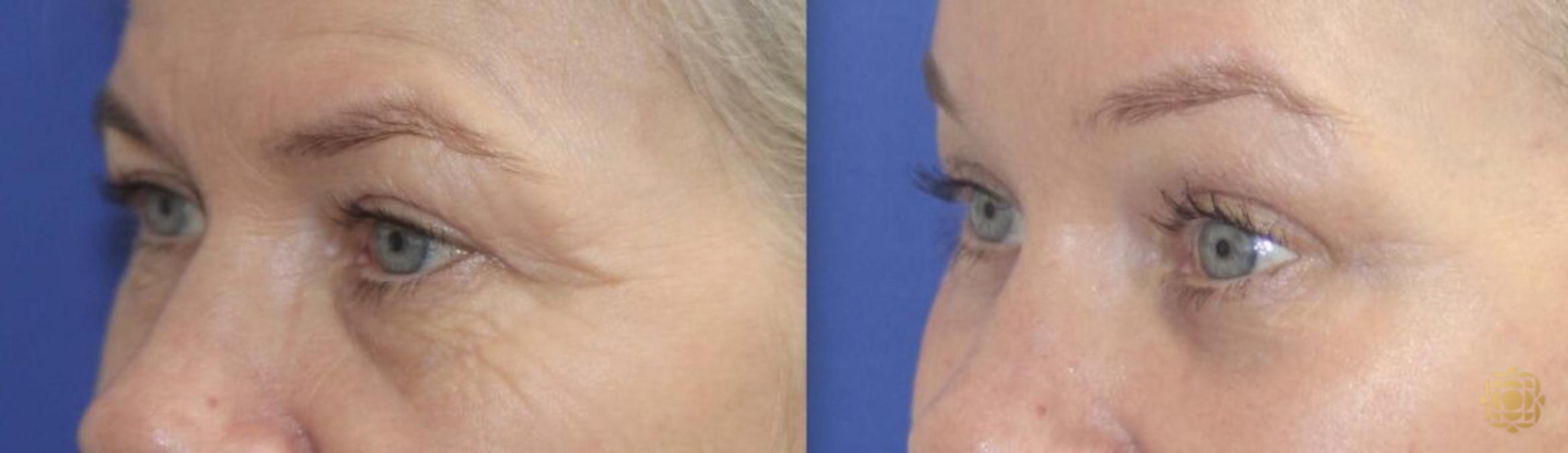 Before & After Brow Lift Case 37 Left Oblique View in Newport Beach, CA
