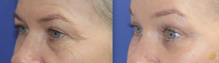 Before & After Brow Lift Case 37 Left Oblique View in Newport Beach, CA