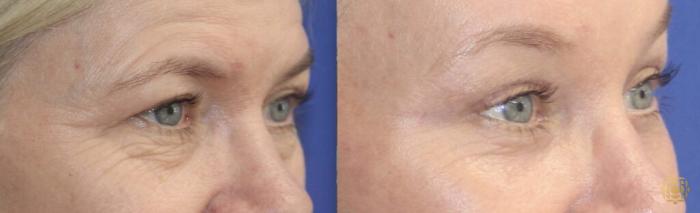 Before & After Brow Lift Case 37 Right Oblique View in Newport Beach, CA