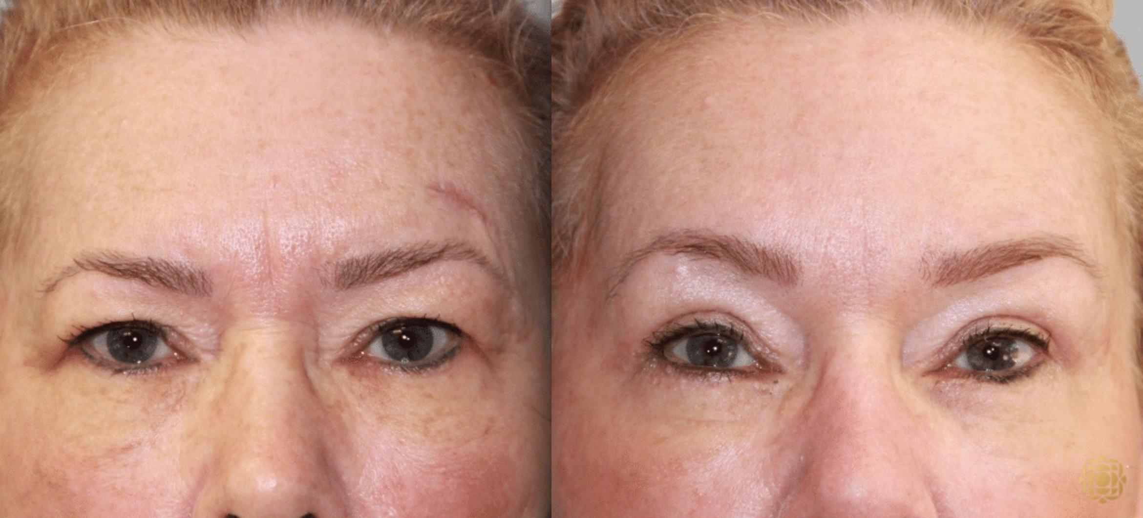Before & After Brow Lift Case 4 View #1 View in Newport Beach, CA
