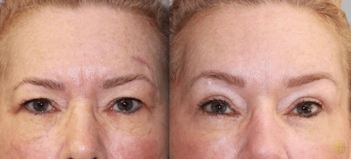 Before & After Brow Lift Case 4 View #1 View in Newport Beach, CA