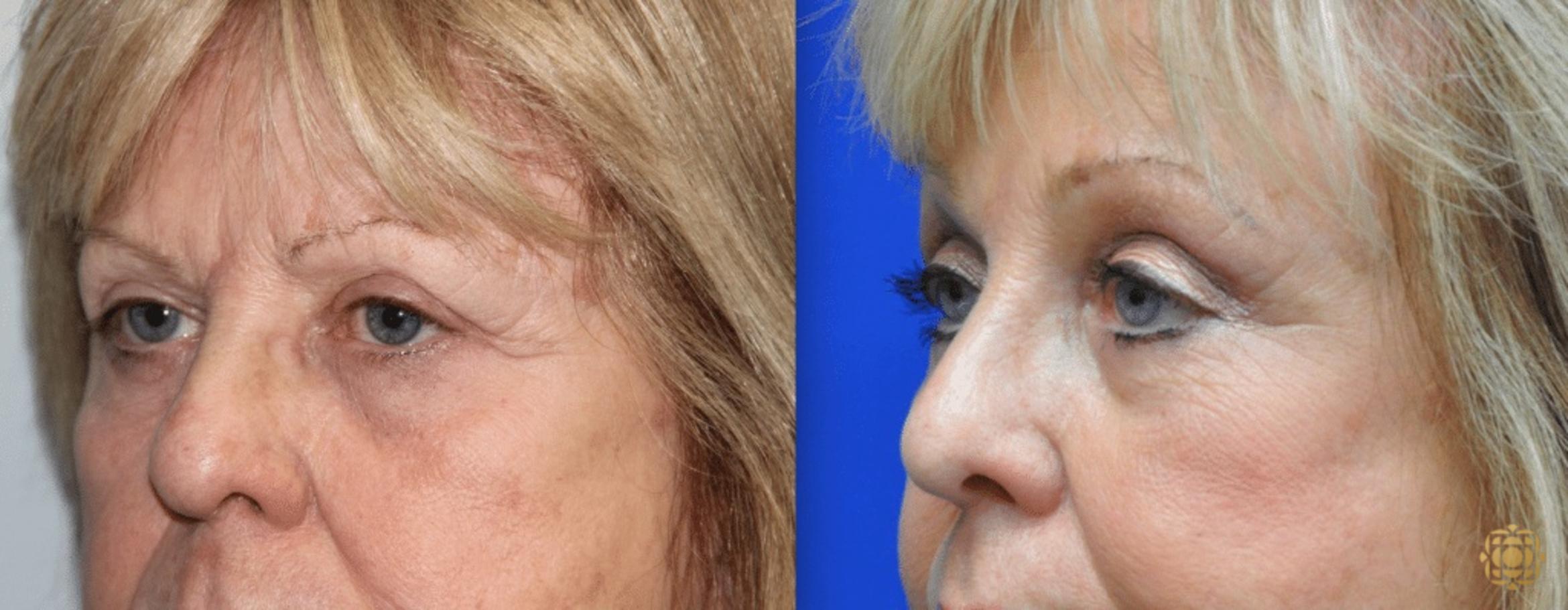 Before & After Brow Lift Case 5 View #1 View in Newport Beach, CA