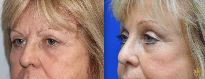 Before & After Brow Lift Case 5 View #1 View in Newport Beach, CA