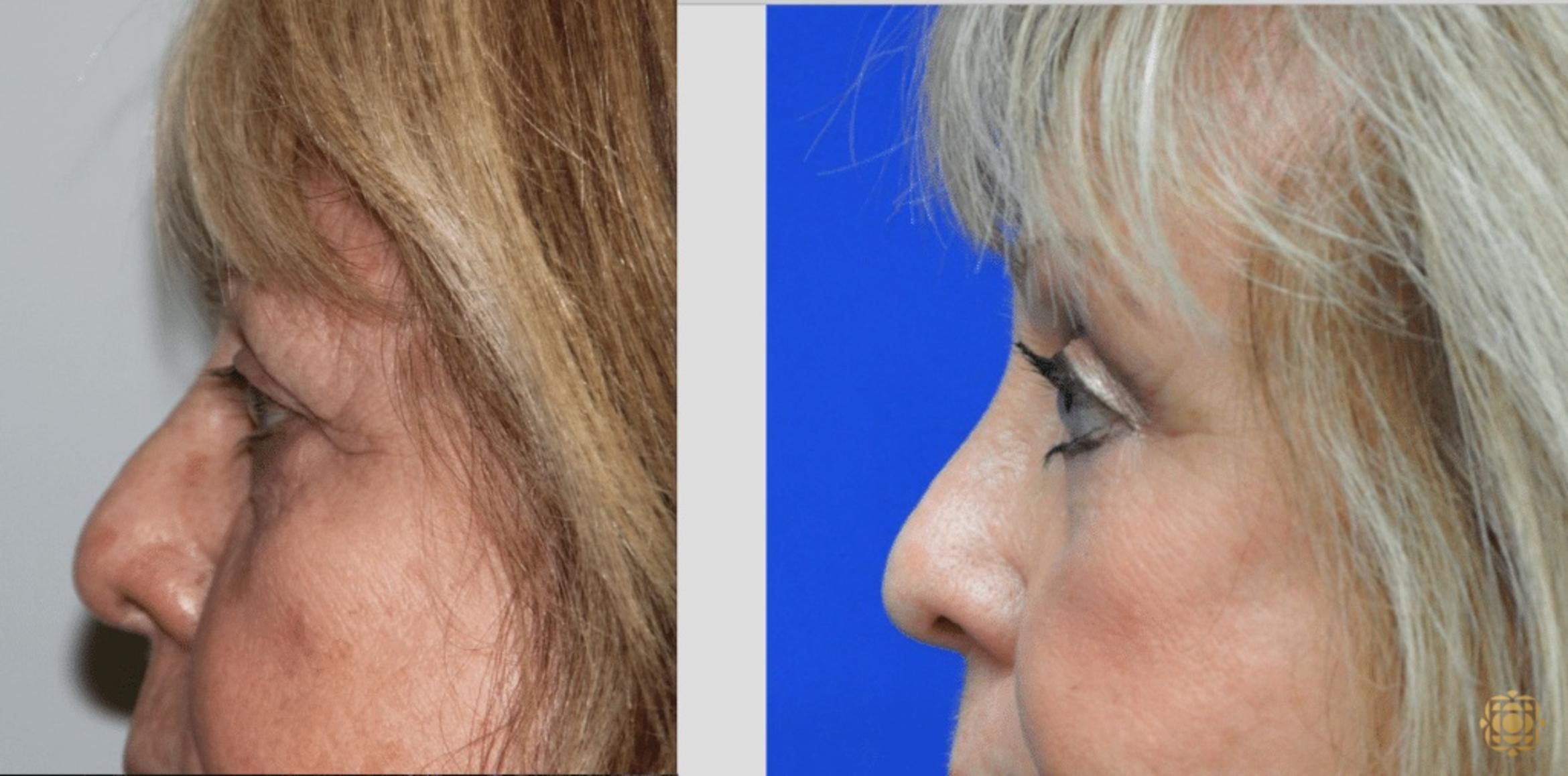 Before & After Brow Lift Case 5 View #2 View in Newport Beach, CA