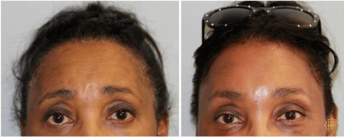 Before & After Brow Lift Case 6 View #1 View in Newport Beach, CA
