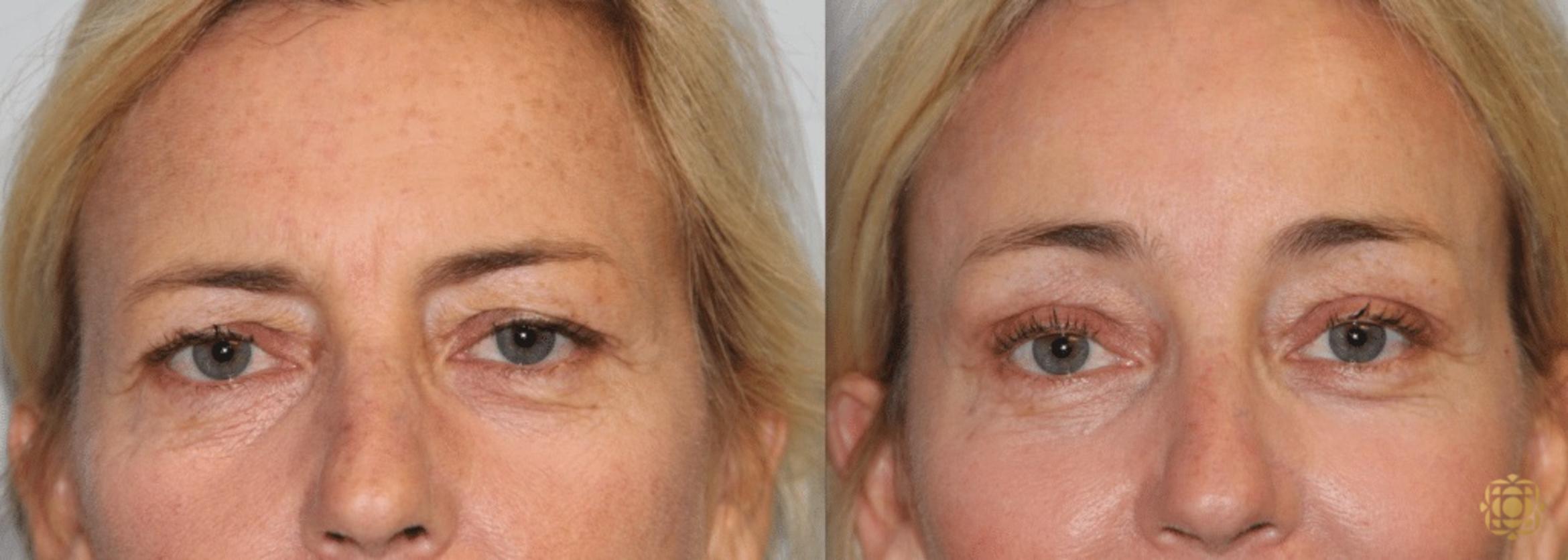 Before & After Brow Lift Case 7 View #1 View in Newport Beach, CA