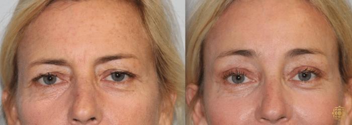 Before & After Brow Lift Case 7 View #1 View in Newport Beach, CA