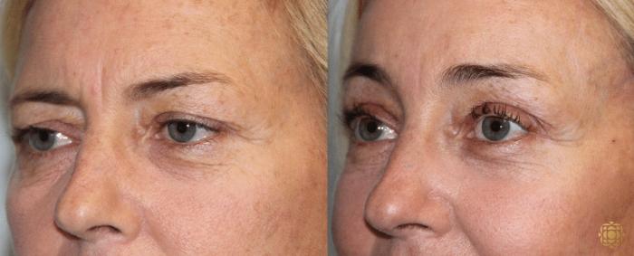 Before & After Brow Lift Case 7 View #2 View in Newport Beach, CA