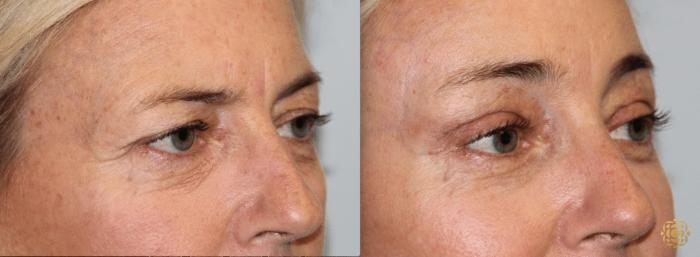 Before & After Brow Lift Case 7 View #3 View in Newport Beach, CA