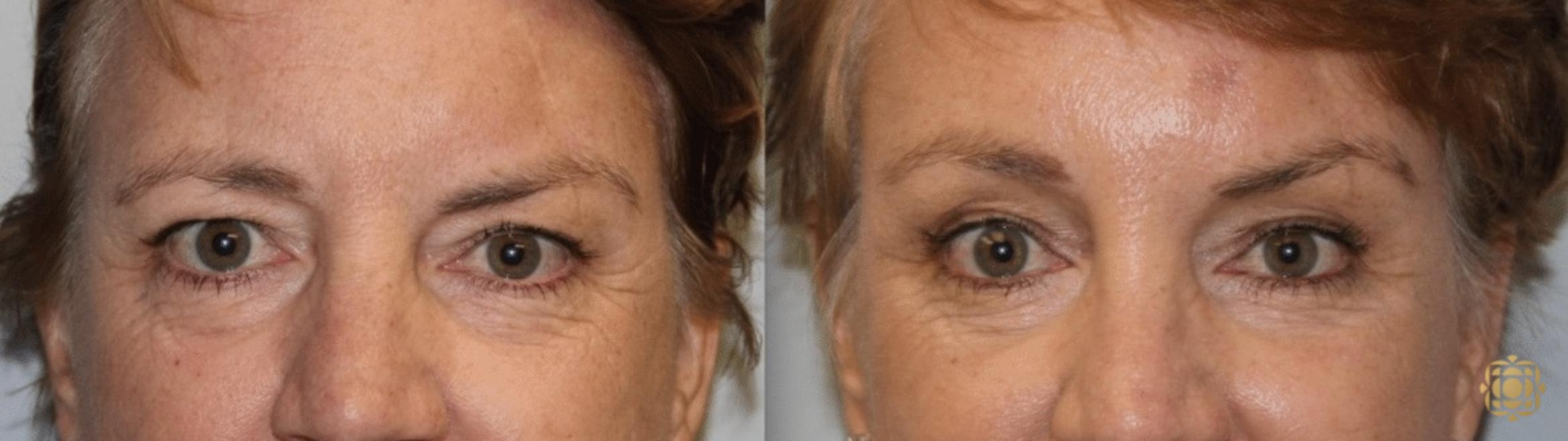 Before & After Brow Lift Case 9 Front View in Newport Beach, CA
