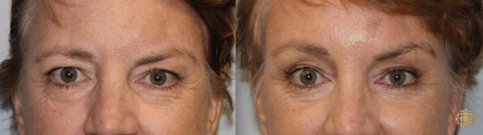 Before & After Brow Lift Case 9 Front View in Newport Beach, CA