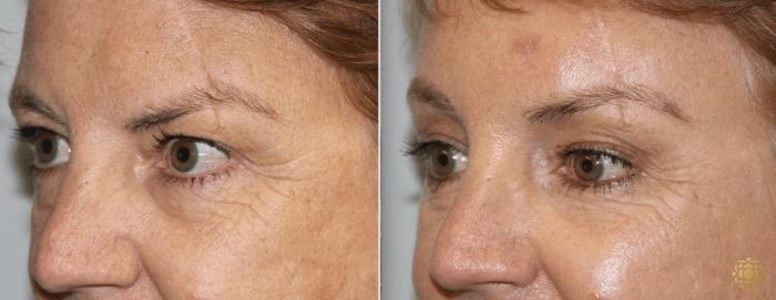 Before & After Brow Lift Case 9 Left Oblique View in Newport Beach, CA