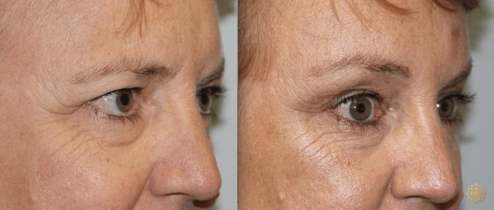 Before & After Brow Lift Case 9 Right Oblique View in Newport Beach, CA