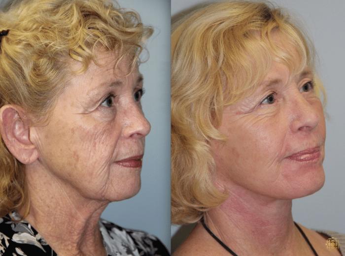 Before & After Chemical Peels Case 392 View #2 View in Newport Beach, CA