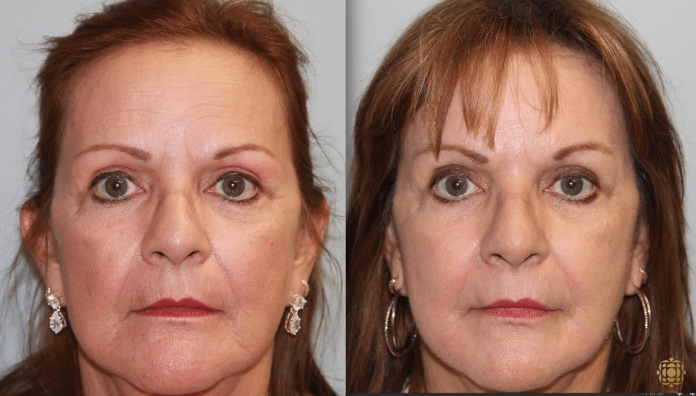 Before & After Chemical Peels Case 393 View #1 View in Newport Beach, CA