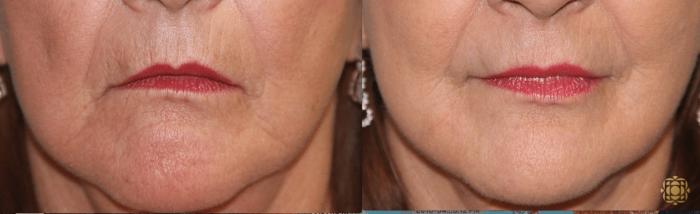 Before & After Chemical Peels Case 393 View #2 View in Newport Beach, CA