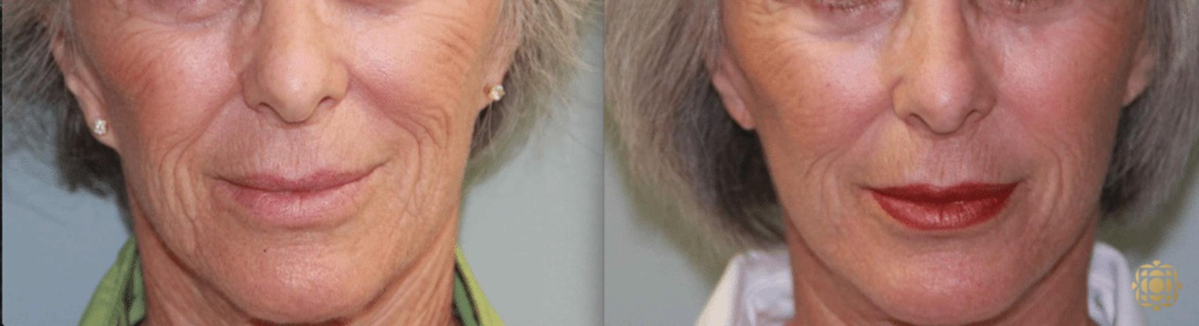 Before & After Chemical Peels Case 394 View #1 View in Newport Beach, CA