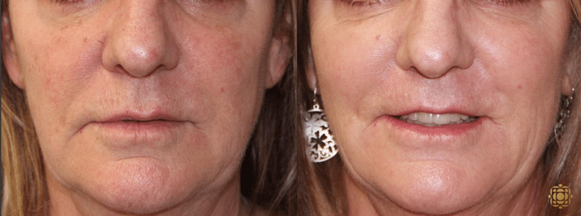Before & After Chemical Peels Case 395 View #1 View in Newport Beach, CA