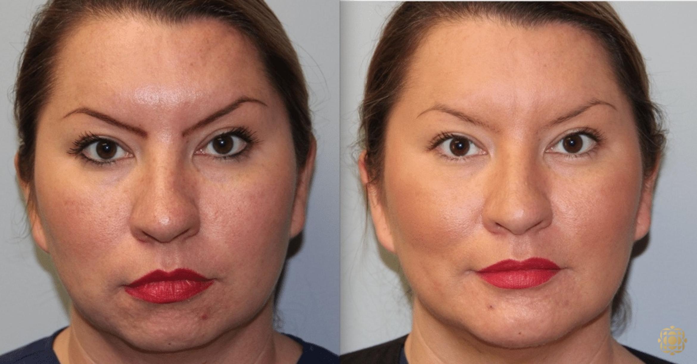 Before & After Chin Augmentation Case 272 Front View in Newport Beach, CA