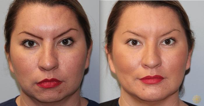 Before & After Chin Augmentation Case 272 Front View in Newport Beach, CA