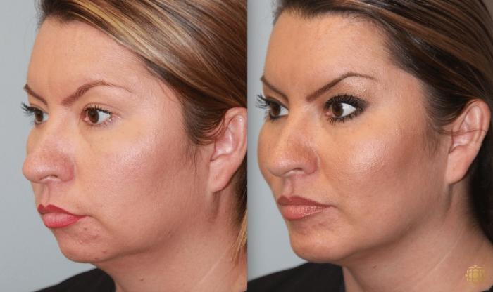 Before & After Chin Augmentation Case 272 Left Oblique View in Newport Beach, CA