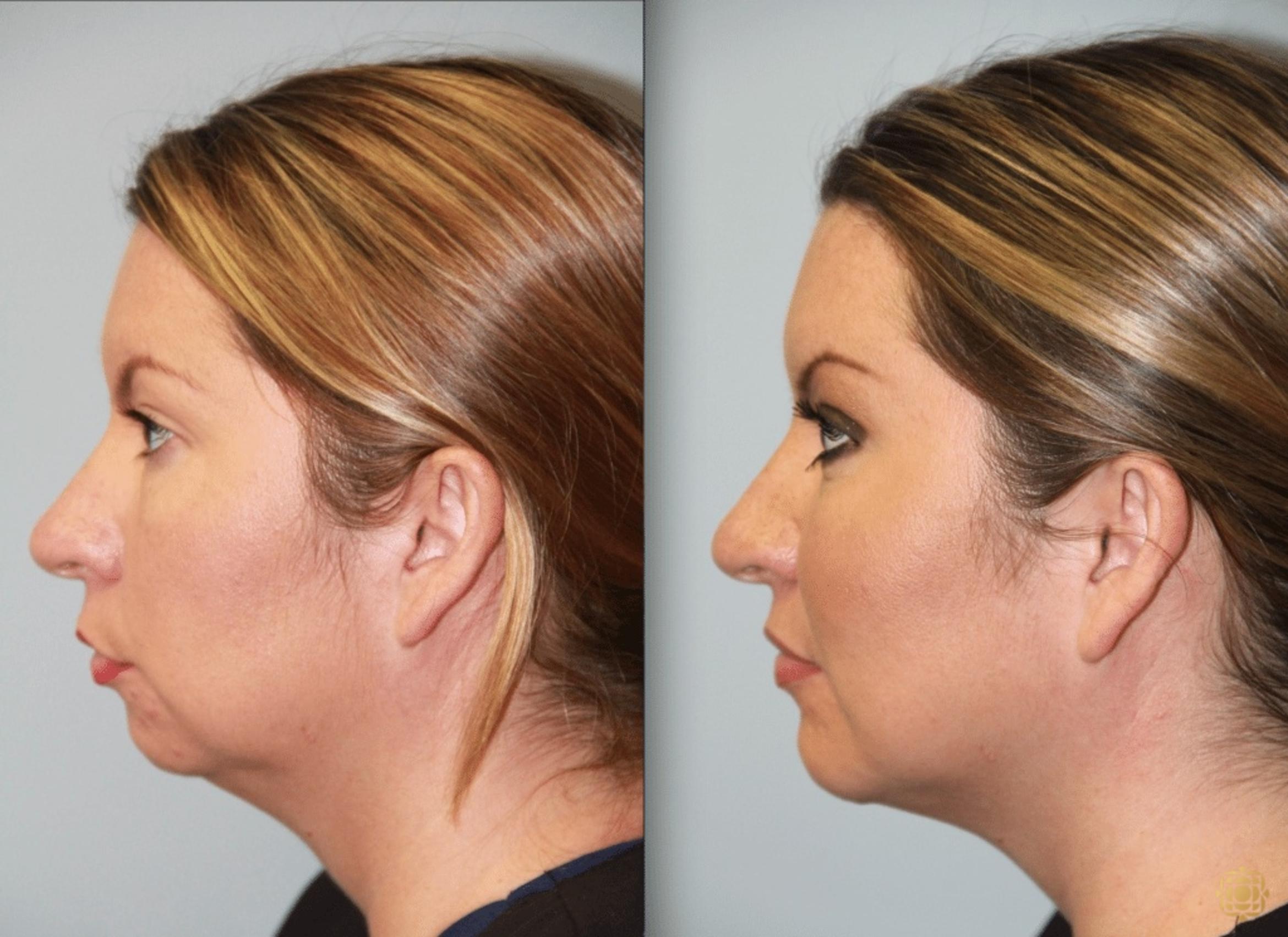 Before & After Chin Augmentation Case 272 Left Side View in Newport Beach, CA