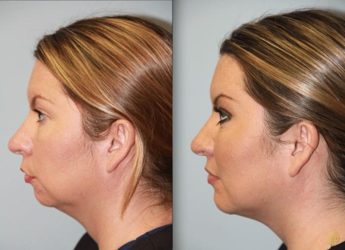Before & After Chin Augmentation Case 272 Left Side View in Newport Beach, CA