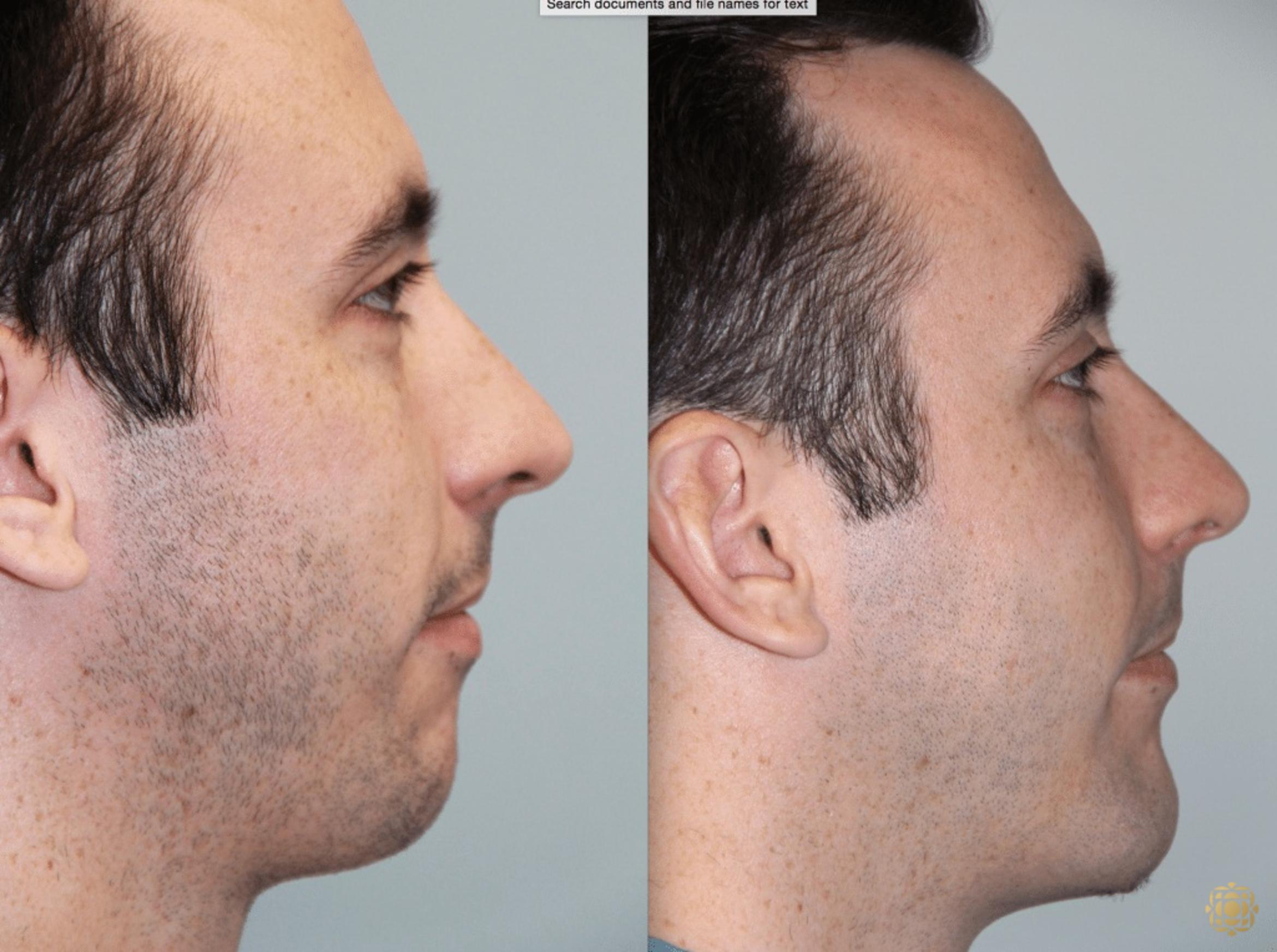 Before & After Chin Augmentation Case 273 View #1 View in Newport Beach, CA