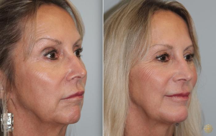 Before & After Chin Augmentation Case 274 Right Oblique View in Newport Beach, CA