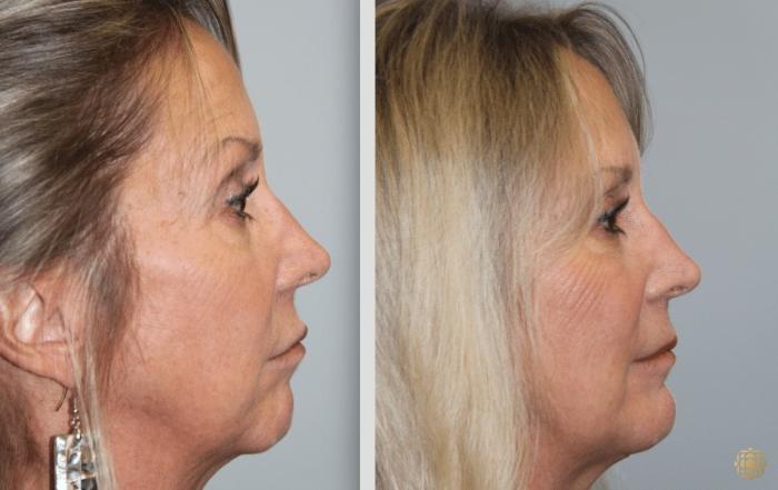 Before & After Chin Augmentation Case 274 Right Side View in Newport Beach, CA