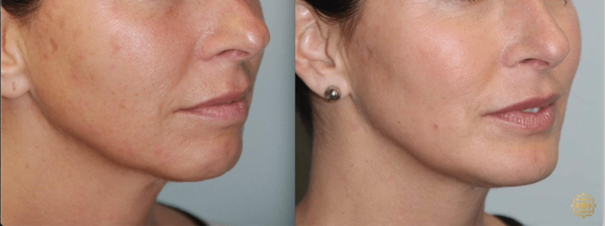 Before & After Chin Augmentation Case 275 View #1 View in Newport Beach, CA