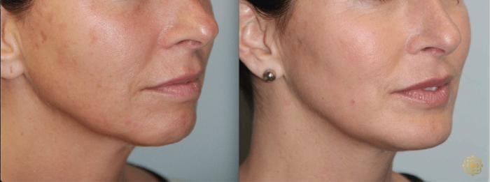 Before & After Chin Augmentation Case 275 View #1 View in Newport Beach, CA