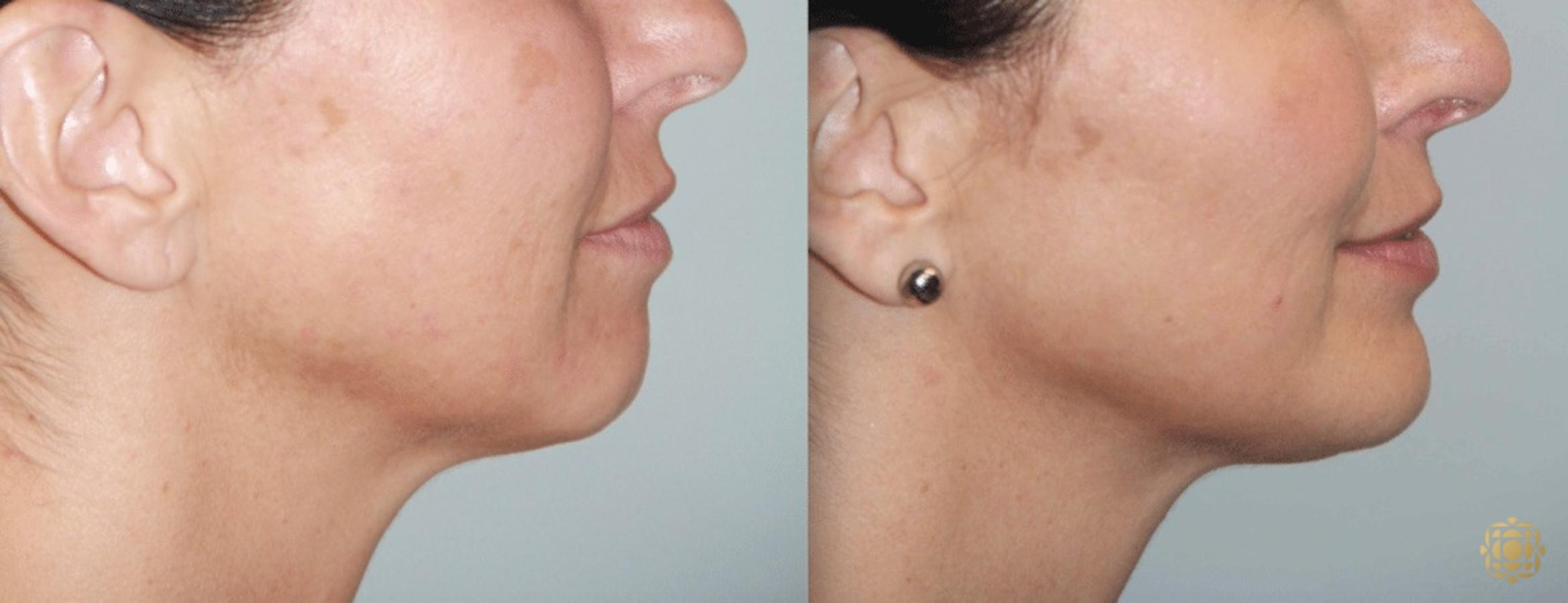 Before & After Chin Augmentation Case 275 View #2 View in Newport Beach, CA