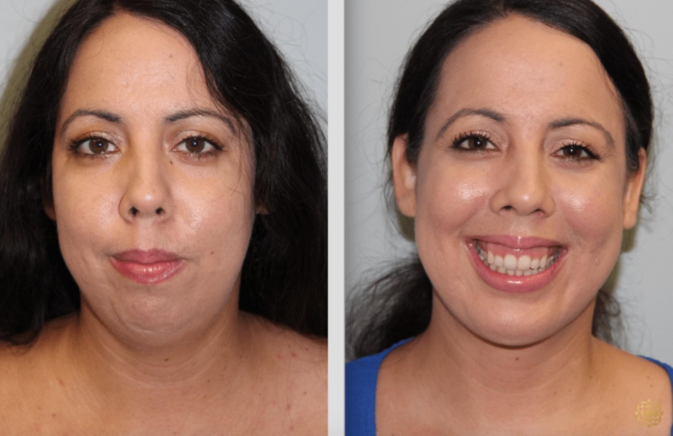 Before & After Chin Augmentation Case 277 View #1 View in Newport Beach, CA