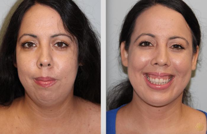 Before & After Chin Augmentation Case 277 View #1 View in Newport Beach, CA