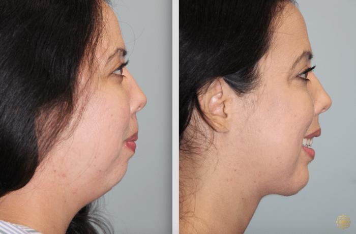 Before & After Chin Augmentation Case 277 View #2 View in Newport Beach, CA