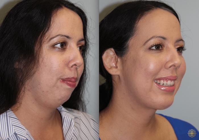 Before & After Chin Augmentation Case 277 View #3 View in Newport Beach, CA