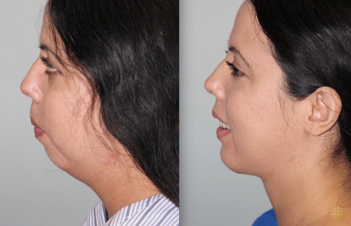 Before & After Chin Augmentation Case 277 View #4 View in Newport Beach, CA