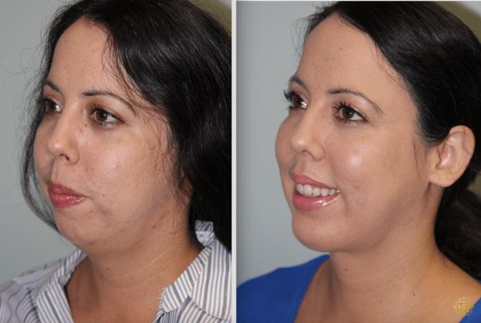 Before & After Chin Augmentation Case 277 View #5 View in Newport Beach, CA