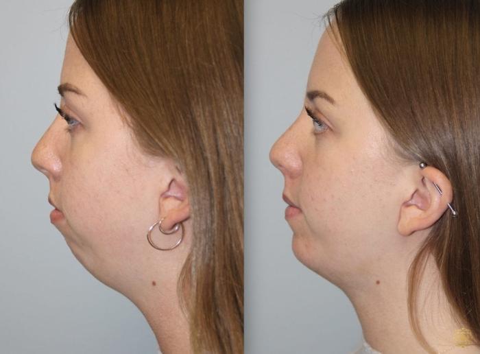 Before & After Chin Augmentation Case 278 View #1 View in Newport Beach, CA