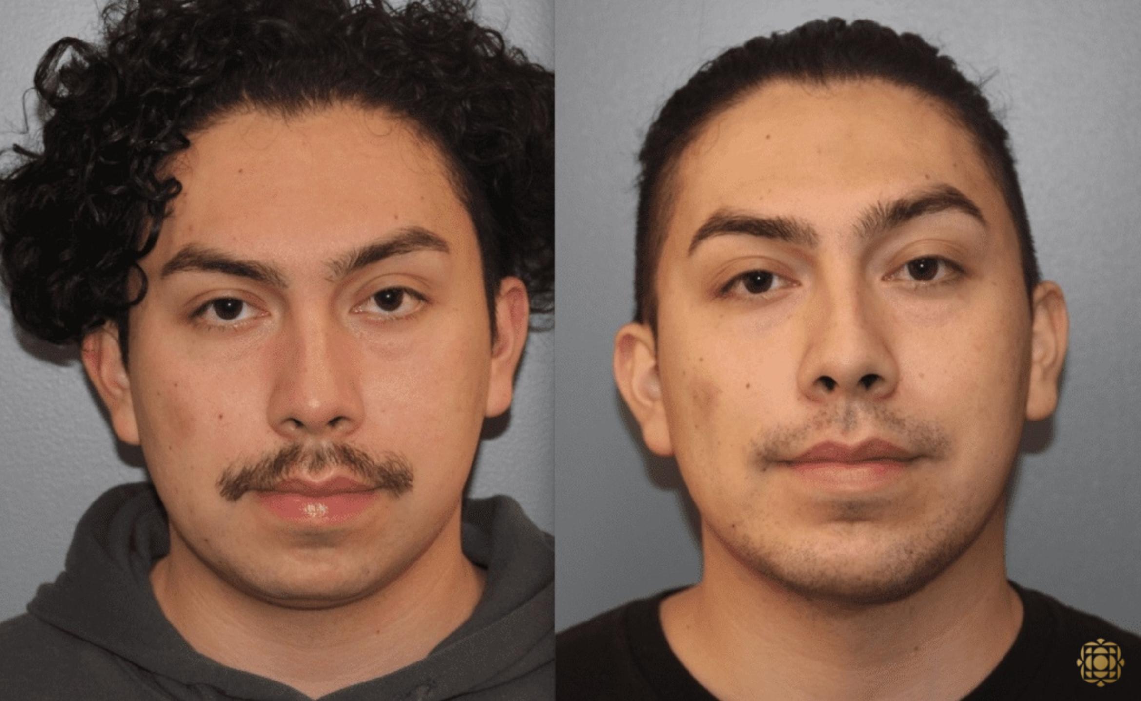 Before & After Chin Augmentation Case 279 Front View in Newport Beach, CA