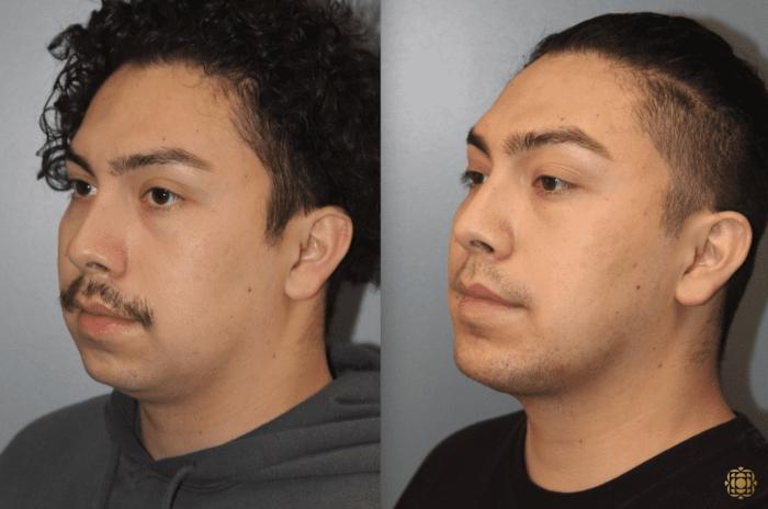 Before & After Chin Augmentation Case 279 Left Oblique View in Newport Beach, CA
