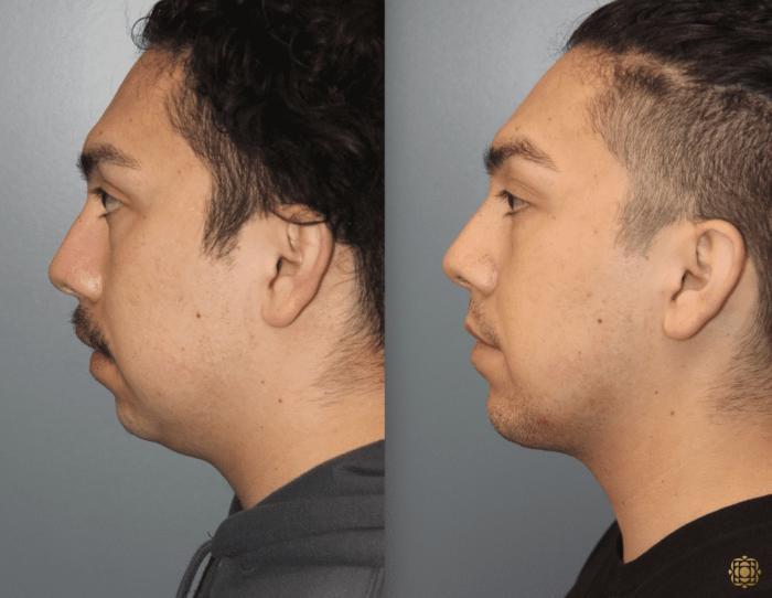 Before & After Chin Augmentation Case 279 Left Side View in Newport Beach, CA
