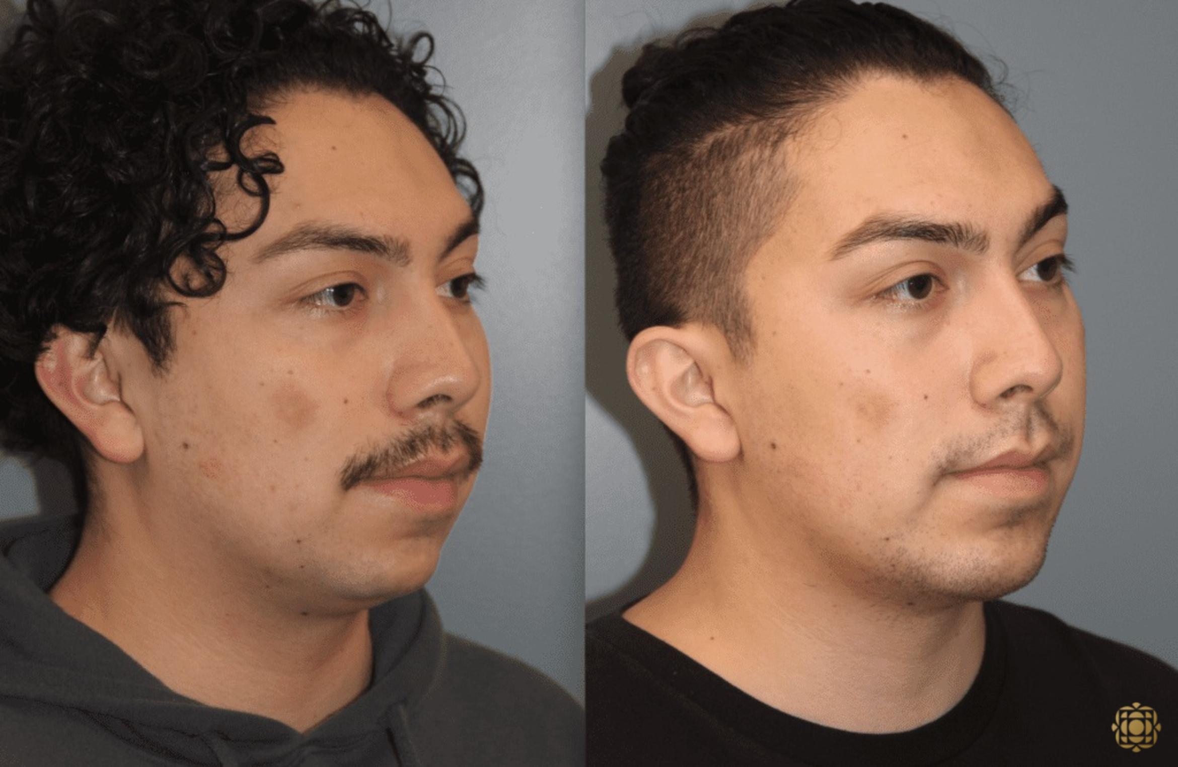 Before & After Chin Augmentation Case 279 Right Oblique View in Newport Beach, CA