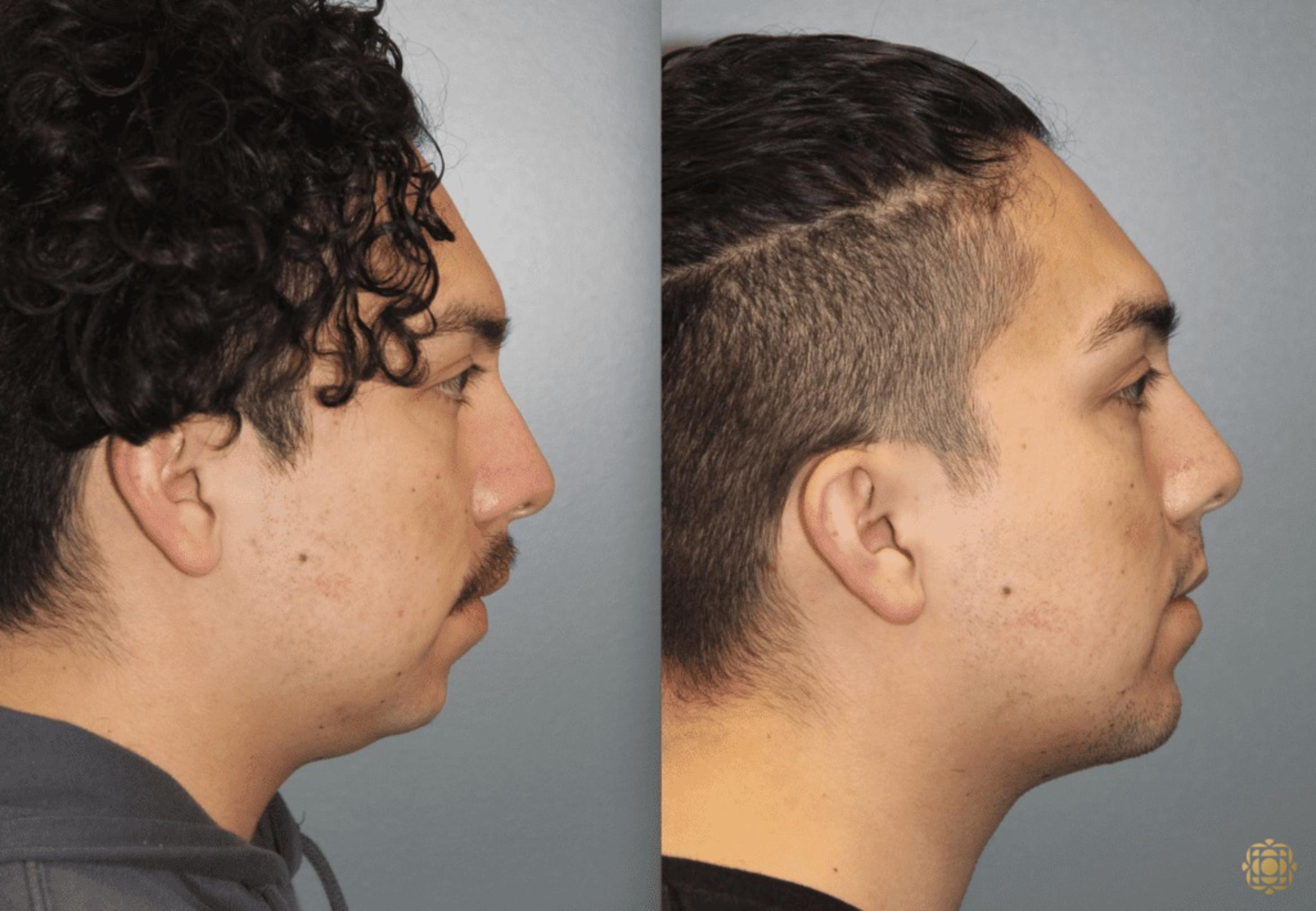 Before & After Chin Augmentation Case 279 Right Side View in Newport Beach, CA