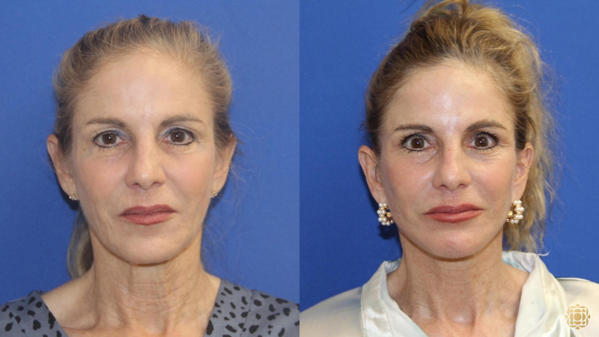 Before & After Fractional CO2 Laser Skin Resurfacing Case 415 Front View in Newport Beach, CA