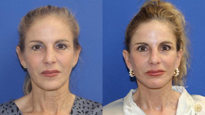 Before & After Fractional CO2 Laser Skin Resurfacing Case 415 Front View in Newport Beach, CA