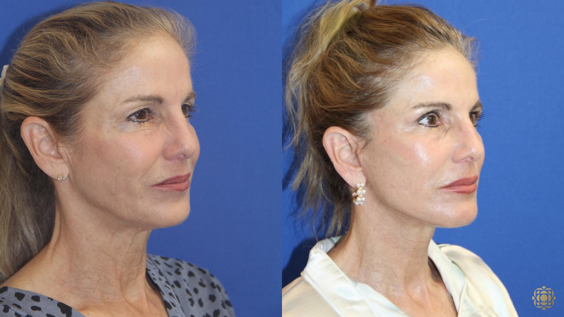 Before & After Fractional CO2 Laser Skin Resurfacing Case 415 Right Oblique View in Newport Beach, CA