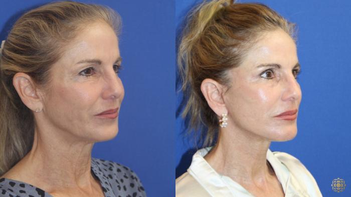 Before & After Fractional CO2 Laser Skin Resurfacing Case 415 Right Oblique View in Newport Beach, CA