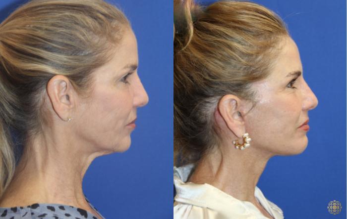 Before & After Fractional CO2 Laser Skin Resurfacing Case 415 Right Side View in Newport Beach, CA